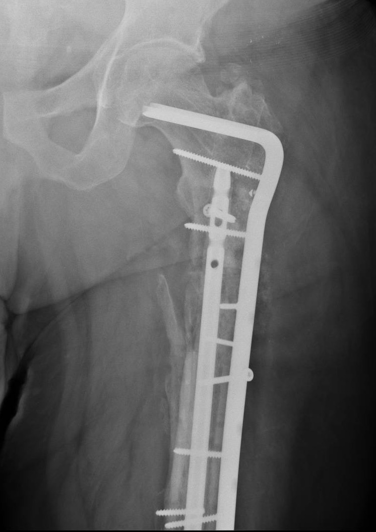 hip xray