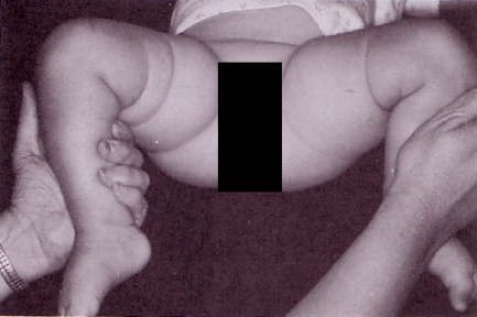 Baby on it's back with legs open and knees raise