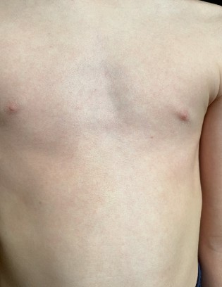 Chest of a young boy