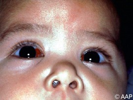 Baby with blood in the corner's of his eyes