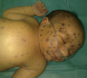 Baby with spots on it's face because it most likely has Congenital CMV